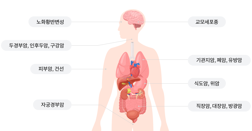 교모세포종/노화황반변성/두부경부암,인후두암,구강암/기관지암,폐암,유방암/피부암,건선/식도암,위암/직장암,대장암,방광암/자궁경부암