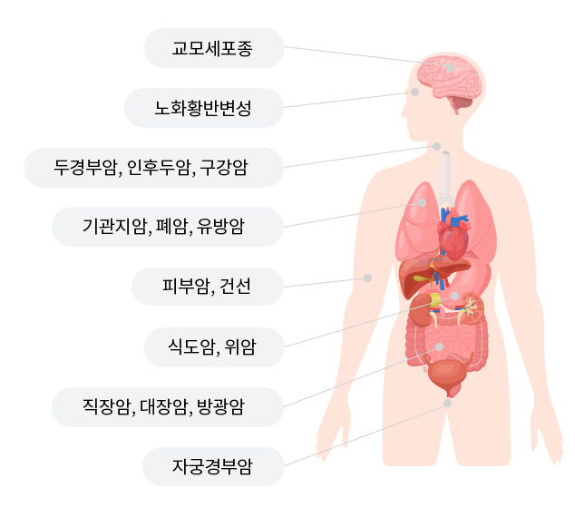 교모세포종/노화황반변성/두부경부암,인후두암,구강암/기관지암,폐암,유방암/피부암,건선/식도암,위암/직장암,대장암,방광암/자궁경부암